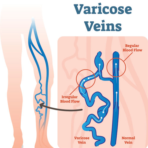 varicose veins pregnancy